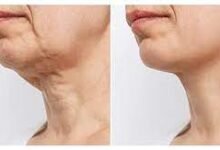 Neck Lift in Dubai