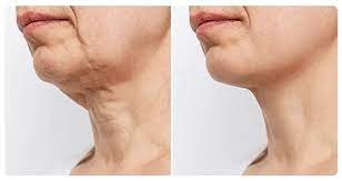 Neck Lift in Dubai